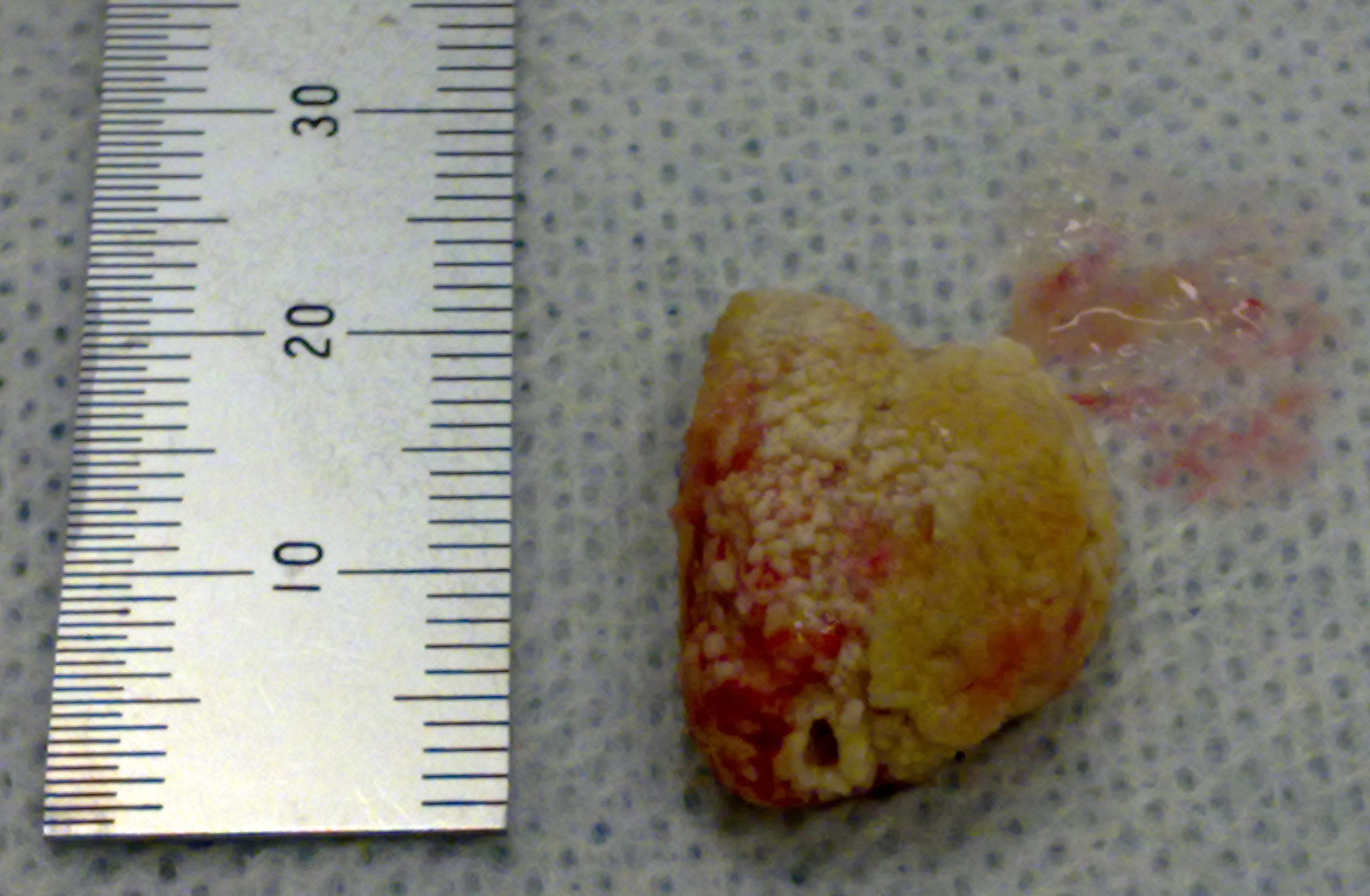 Release of Salivary Stones3